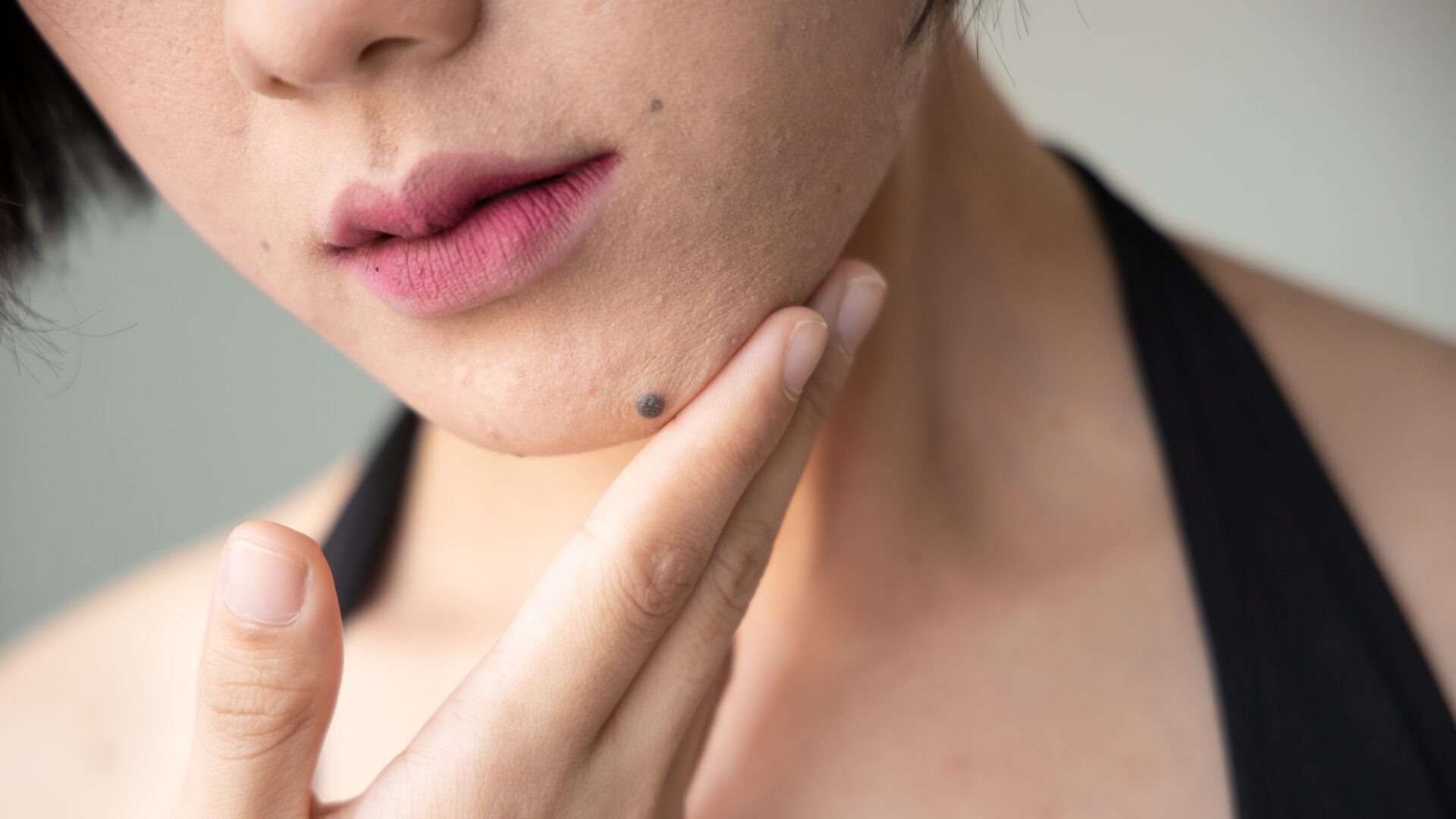 how-to-remove-moles-on-face-permanently