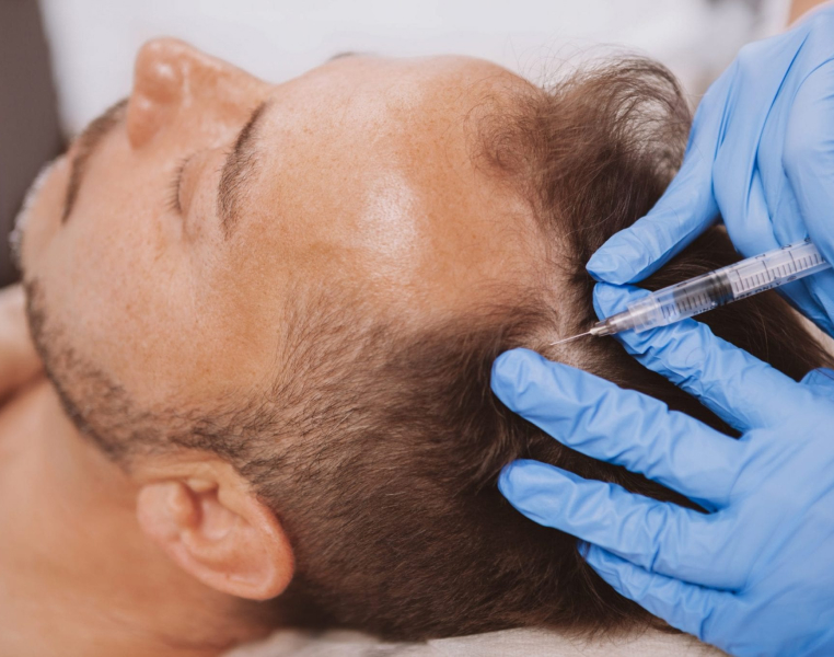 Patient at Akarshan Clinic receiving the Growth Factor Concentrate (GFC) Hair Treatment