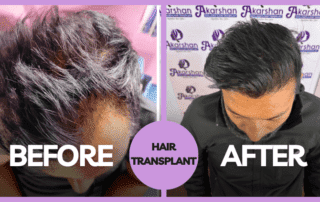 Hair Transplant before and after (1)