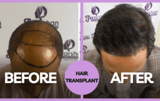 Hair Transplant before and after