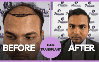 hair transplant, Hair loss prevention tips, Hair Transplant clinic in Nepal