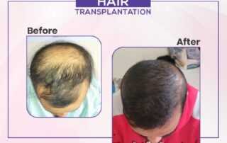 hair transplant results before and after