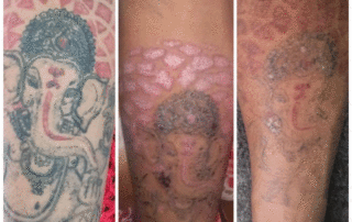 tattoo removal after 3rd session