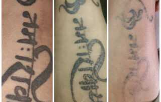 tattoo removal after 3 session results