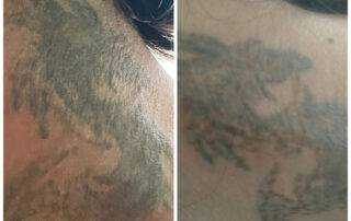 tattoo removal after 1 session in nepal, kathmandu