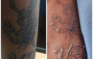 tattoo removal after 1 hours