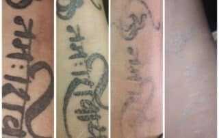 tattoo removal result in kathmandu