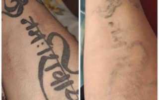 tattoo removal in nepal