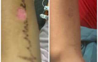 tattoo removal near me