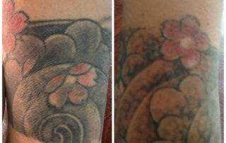 tattoo removal after session in kathmandu