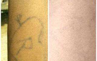 tattoo removal result near me