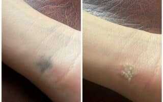 after 1 hour tattoo removal