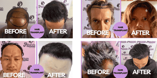 Hair Transplants What to Expect and Costs Explained