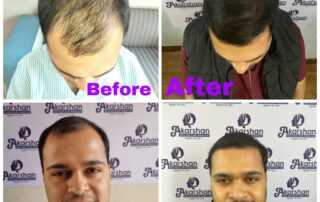 hair transplant results