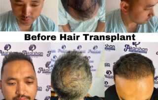 hair transplant result after 8 months