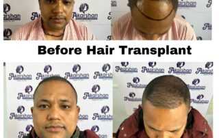 hair transplant result after 3 months