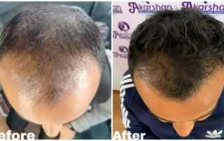 hair transplant result before and after