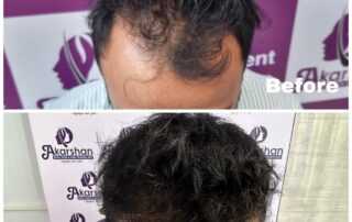 hair transplant near me