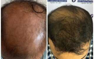 hair transplant in kathmandu