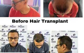 hair transplant result after 5 months