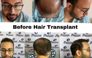 hair transplant result after 7 months