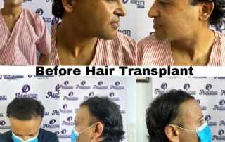 hair transplant in nepal, kathmandu