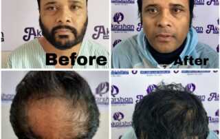 hair transplant crown area results