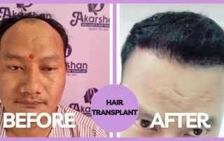 hair transplant results in nepal, Kathmandu
