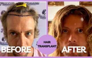 hair transplant result international patient