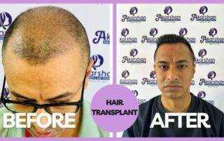 hair transplant result in nepal