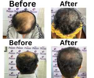 hair transplant result before & after