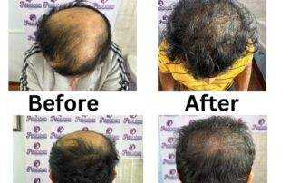 hair transplant result before & after