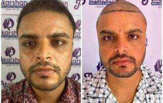 hair transplant results after 6 months