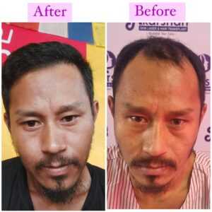 hair transplant result after 6 and half months