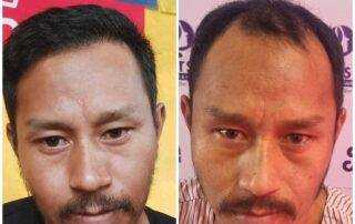 hair transplant result after 6 and half months