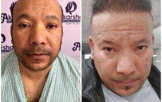 hair transplant result after 7 and half months