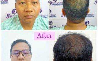 hair transplant result after 5 months