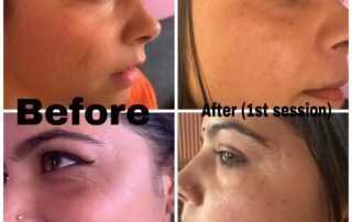 scar treatment co2 laser before after