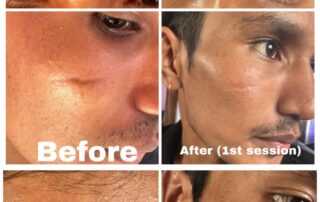 scar treatment co2 laser before after 3rd session