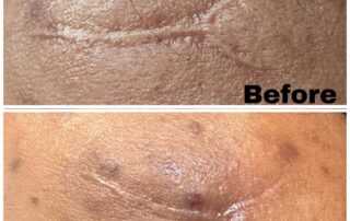 scar treatment co2 laser before after 1st session