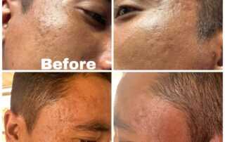 scar treatment co2 laser before after 2nd session
