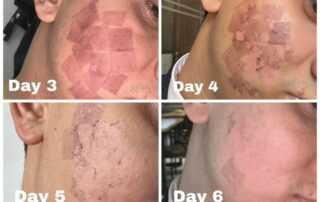 scar treatment co2 laser treatment 1st to 8th days