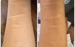scar treatment co2 laser treatment near me