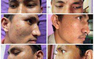 scar treatment co2 laser treatment near me after 1st session