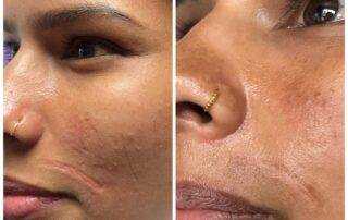 scar treatment co2 laser treatment in nepal, kathmandu after 1st session