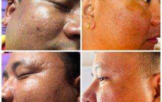 scar treatment co2 laser treatment in kathmandu after 1st session