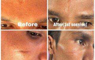 scar treatment co2 laser treatment in kathmandu after 1st session