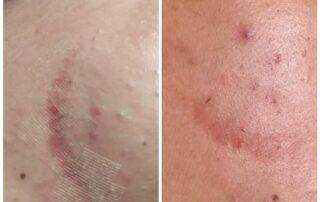 scar treatment co2 laser treatment after 1st session