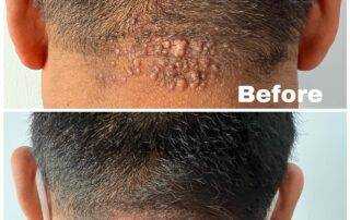 scar treatment co2 laser treatment after