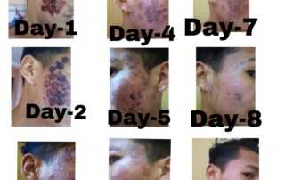scar treatment co2 laser treatment from day 1 to day 9